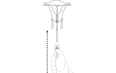 Illustration showing the final position placement for IUD insertion.